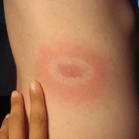 Borrelioza lyme - boala lyme